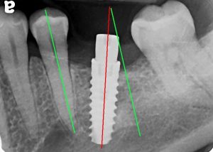 علت کج شدن پایه ایمپلنت دندان 213596203712