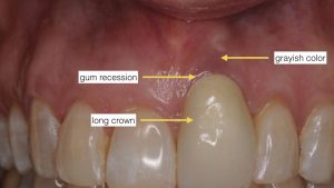 علت کج شدن پایه ایمپلنت دندان 8962130755201